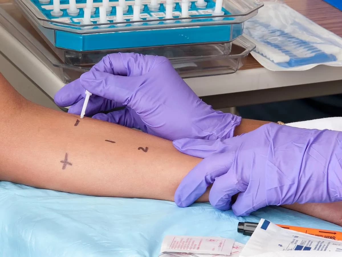Prick-tests cutanés : allergènes déposés sur l'avant-bras et piqués à la lancette